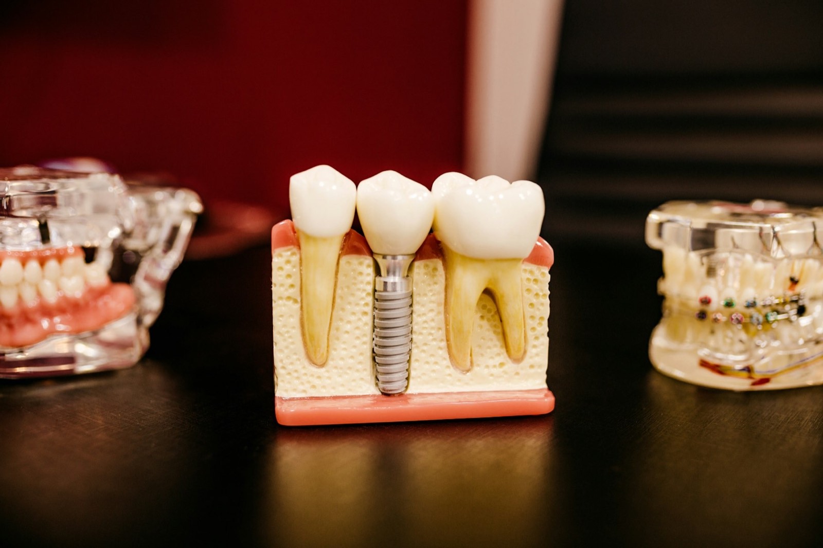 Ceramic crowns and an implant model on a dark surface